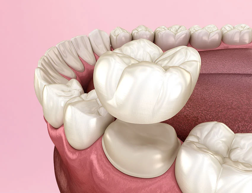 Dental Crowns