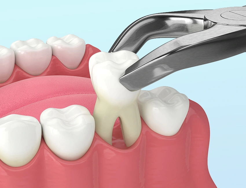 Painless Tooth Extraction