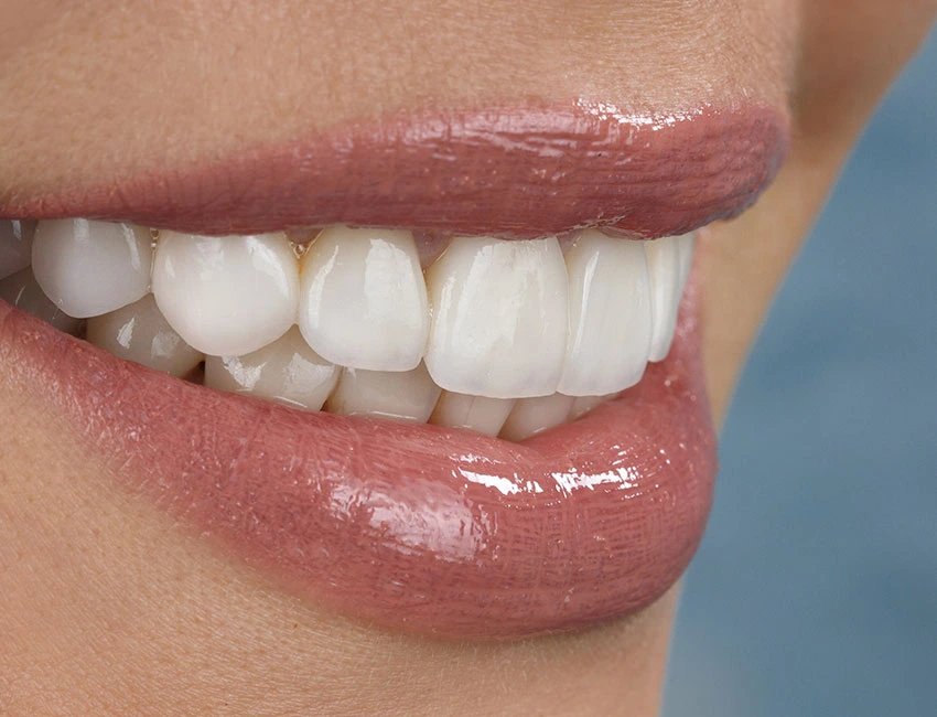 Perfect smile with dental veneers