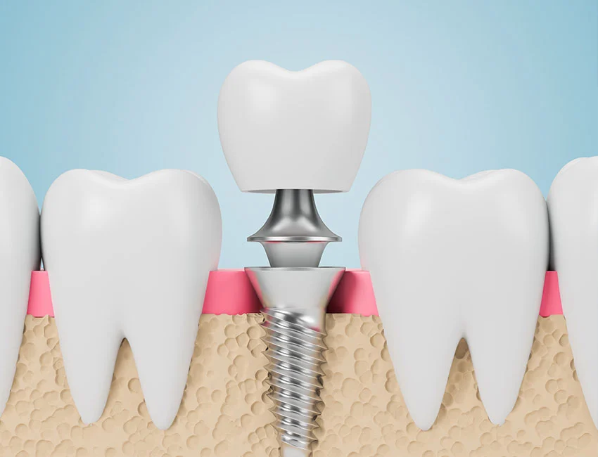 Top quality dental implants