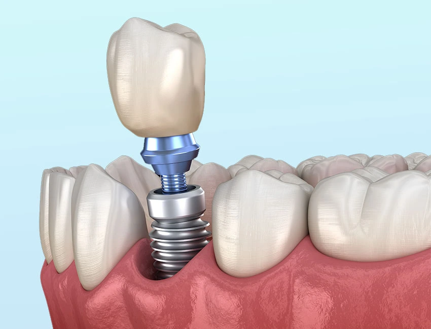 Single tooth dental implant