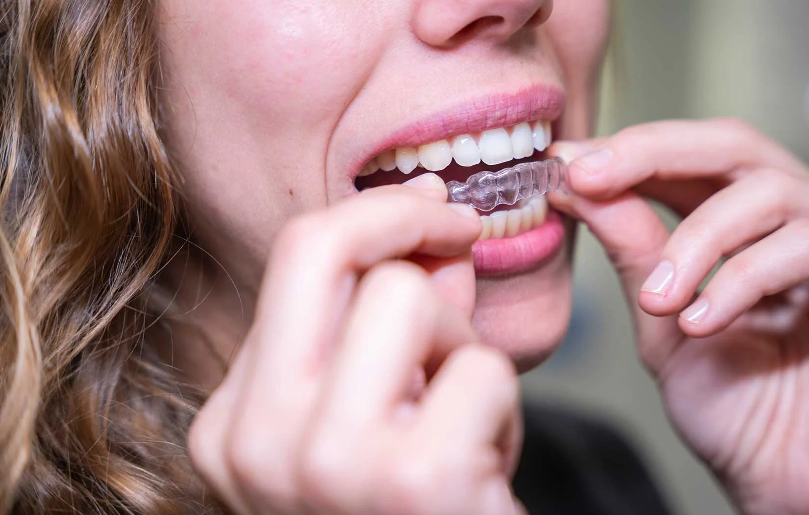 Patient with Invisalign in Cameron Park, CA