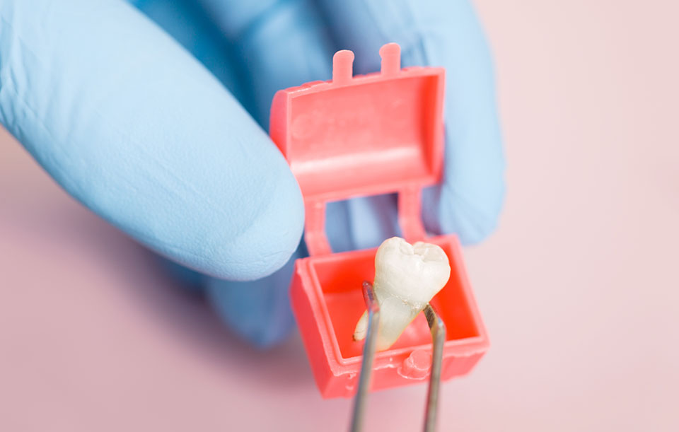 Patients wisdom teeth removed in Cameron Park, CA